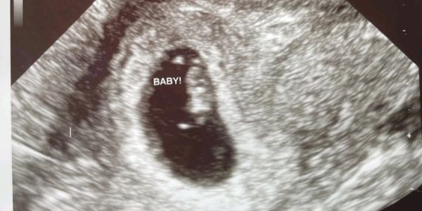 Ultrasound image showing an early-stage pregnancy with the baby labeled.