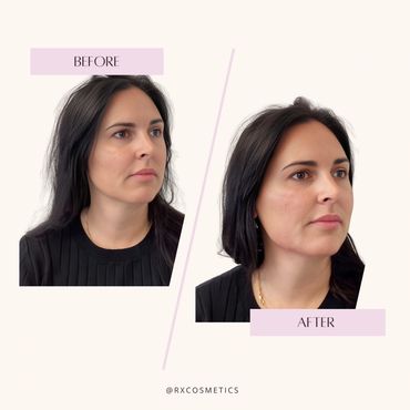 Fat reduction Lindsay ON
Acne treatment aesthetic clinic
Rosacea laser therapy Ontario
Hormone thera