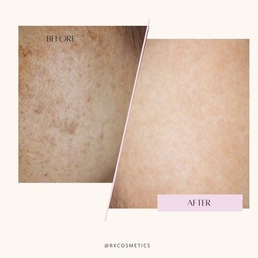 Botox Lindsay
Juvederm fillers Kawarthas
Microneedling treatment Ontario