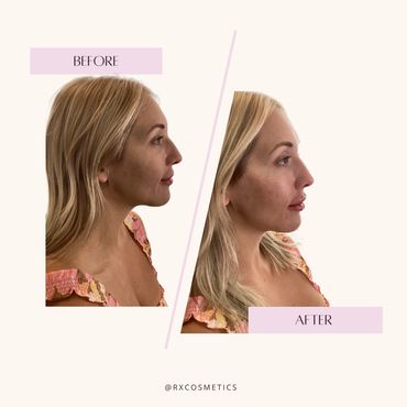 What to expect after Botox

How long do filler results last

Real client transformations