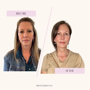 PRP skin results

Chemical peel before and after