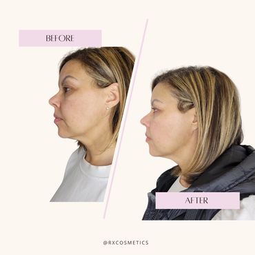 Lip filler before and after

Skin rejuvenation before and after

Anti-aging results

Non-surgical ma