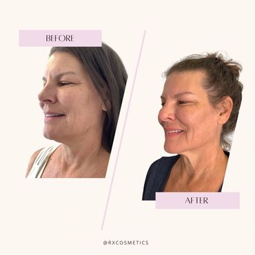 Acne treatment aesthetic clinic
Rosacea laser therapy Ontario
Hormone therapy medspa
Facial rejuvena