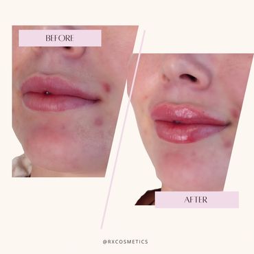 Chemical peel clinic Lindsay
IPL phototherapy Kawarthas
Fat reduction Lindsay ON
Acne treatment aest