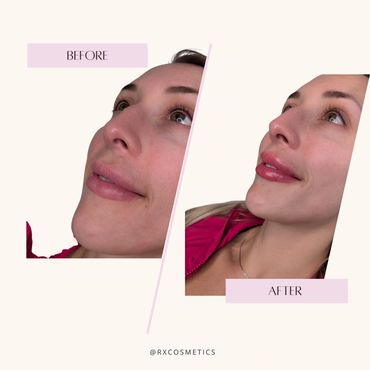 Acne treatment aesthetic clinic
Rosacea laser therapy Ontario
Hormone therapy medspa
Facial rejuvena