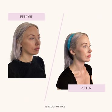 Cosmetic clinic Lindsay

RxCosmetics Kawrathas

Medical aesthetic Peterborough