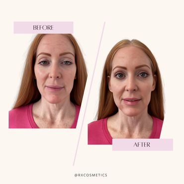 Cosmetic clinic before and after

Botox before and after

Filler before and after