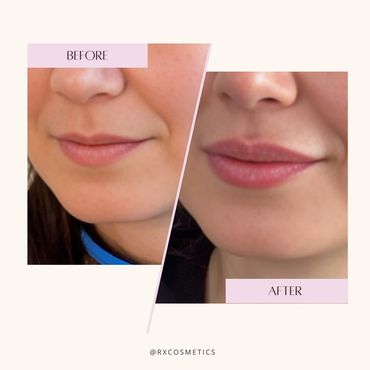 Botox results Toronto / Botox before and after Toronto

Dermal filler results Ontario

Lip enhanceme