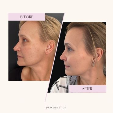 Cheek filler transformation

Microneedling before and after

Laser facial before and after