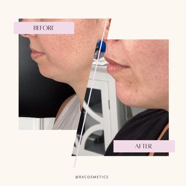 Chemical peel clinic Lindsay
IPL phototherapy Kawarthas
Fat reduction Lindsay ON