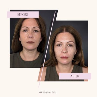 Acne treatment aesthetic clinic
Rosacea laser therapy Ontario
Hormone therapy medspa