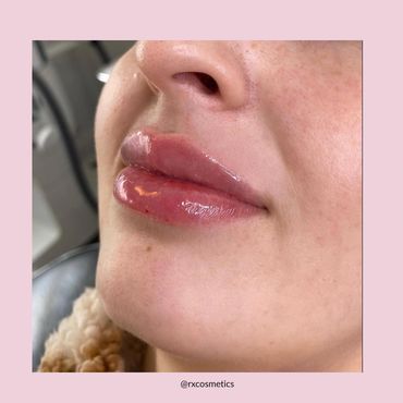 Botox Lindsay
Juvederm fillers Kawarthas
Microneedling treatment Ontario
Chemical peel clinic Lindsa