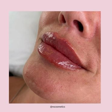 Botox Lindsay
Juvederm fillers Kawarthas
Microneedling treatment Ontario