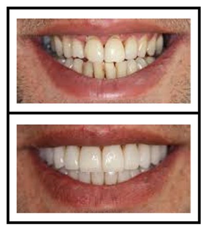 Dental Contouring