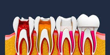 drawing showing the sequence of an infected tooth getting a root canal treatment and a dental crown