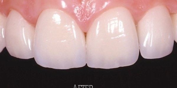 Dental Restoration with e.max Press