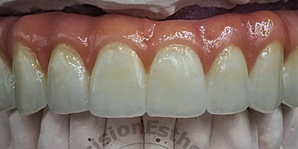 translucent ceramo-hybrid with IPS e.max ZirCAD Prime