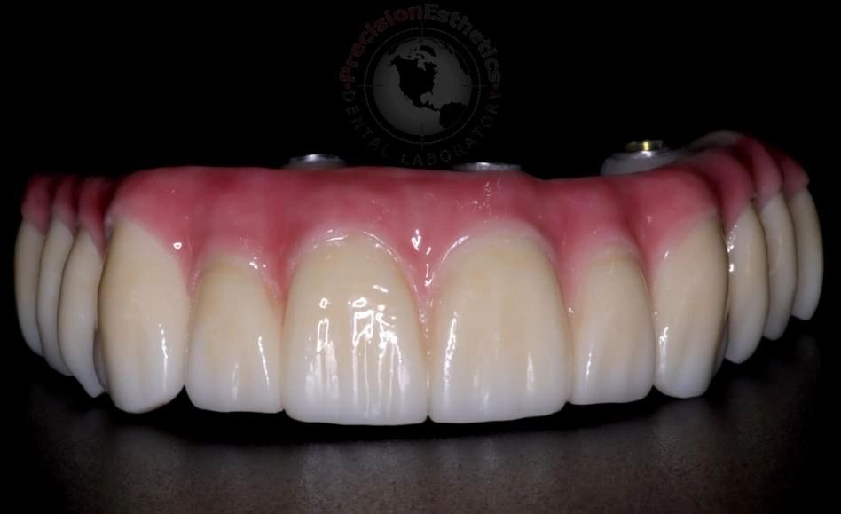 Emax Crown Restoration Services - Blue Box Dental Laboratory