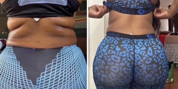 Before and after results from Powers Lipo Shots in Lincoln NE