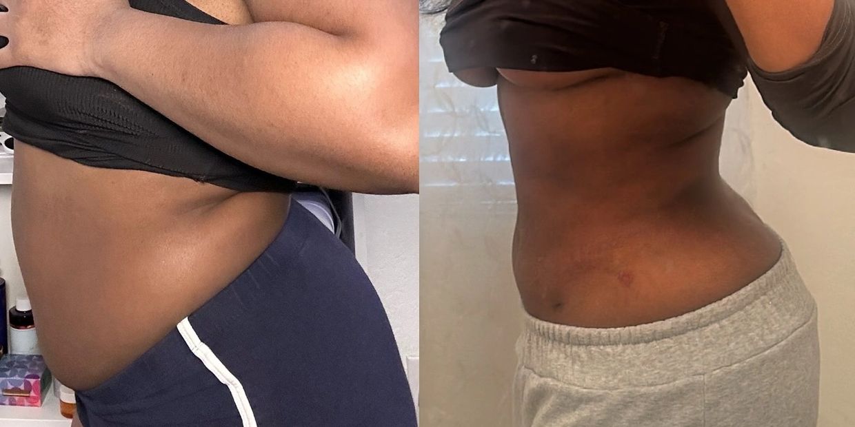 Before and after results of Powers Lipo Shots in Lincoln NE