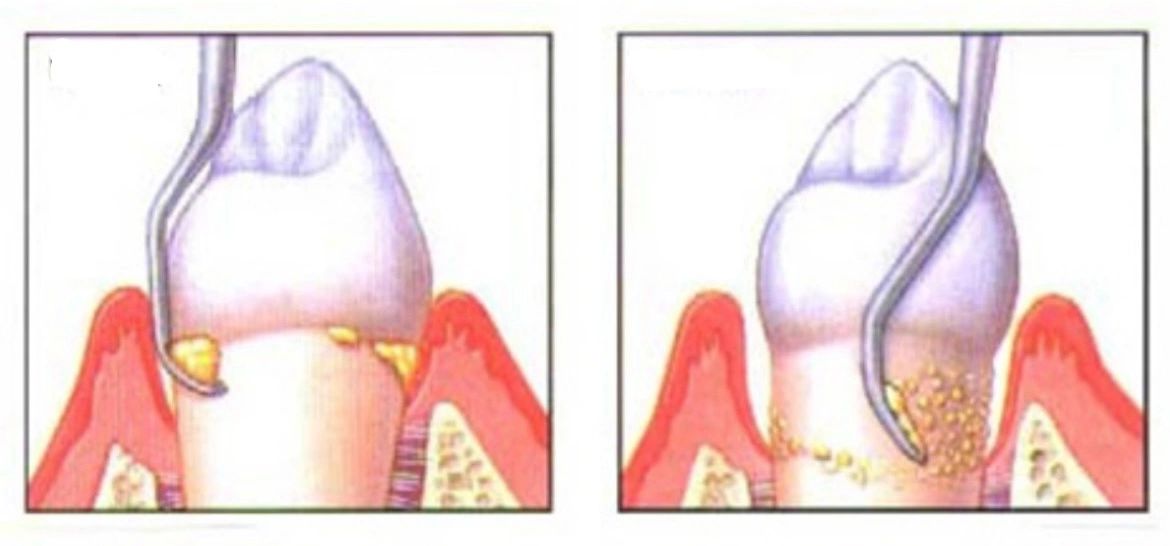 Dental Cleaning vs. Periodontal Maintenance
