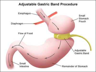 Virtual Gastric Banding Hypnotherapy , loose weight easily



