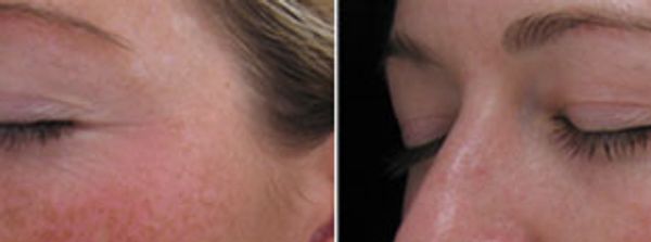 Skin Rejuvenation , Sun Damage