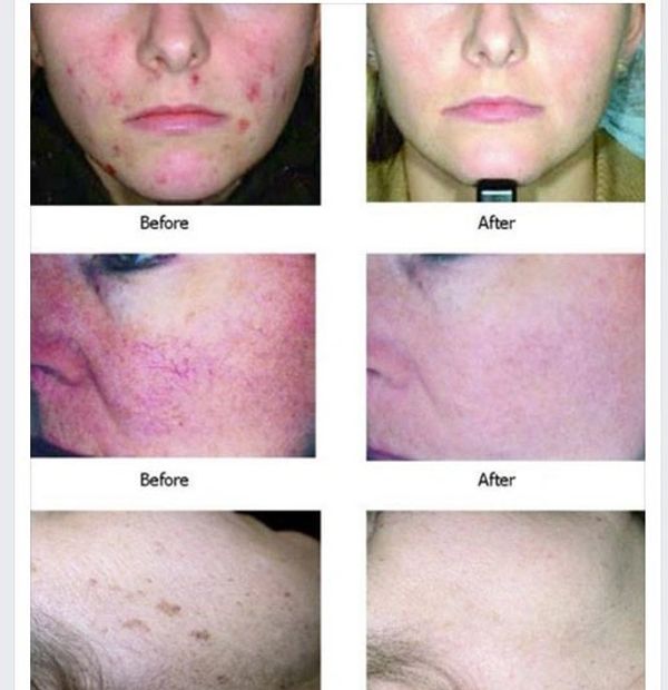 Skin Rejuvenation , Acne Scars, Spider Veins, Age Spots, Sun Damage