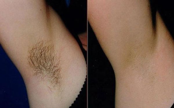 Underarms hair removal