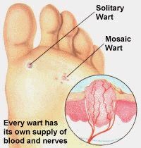 black dots warts on feet