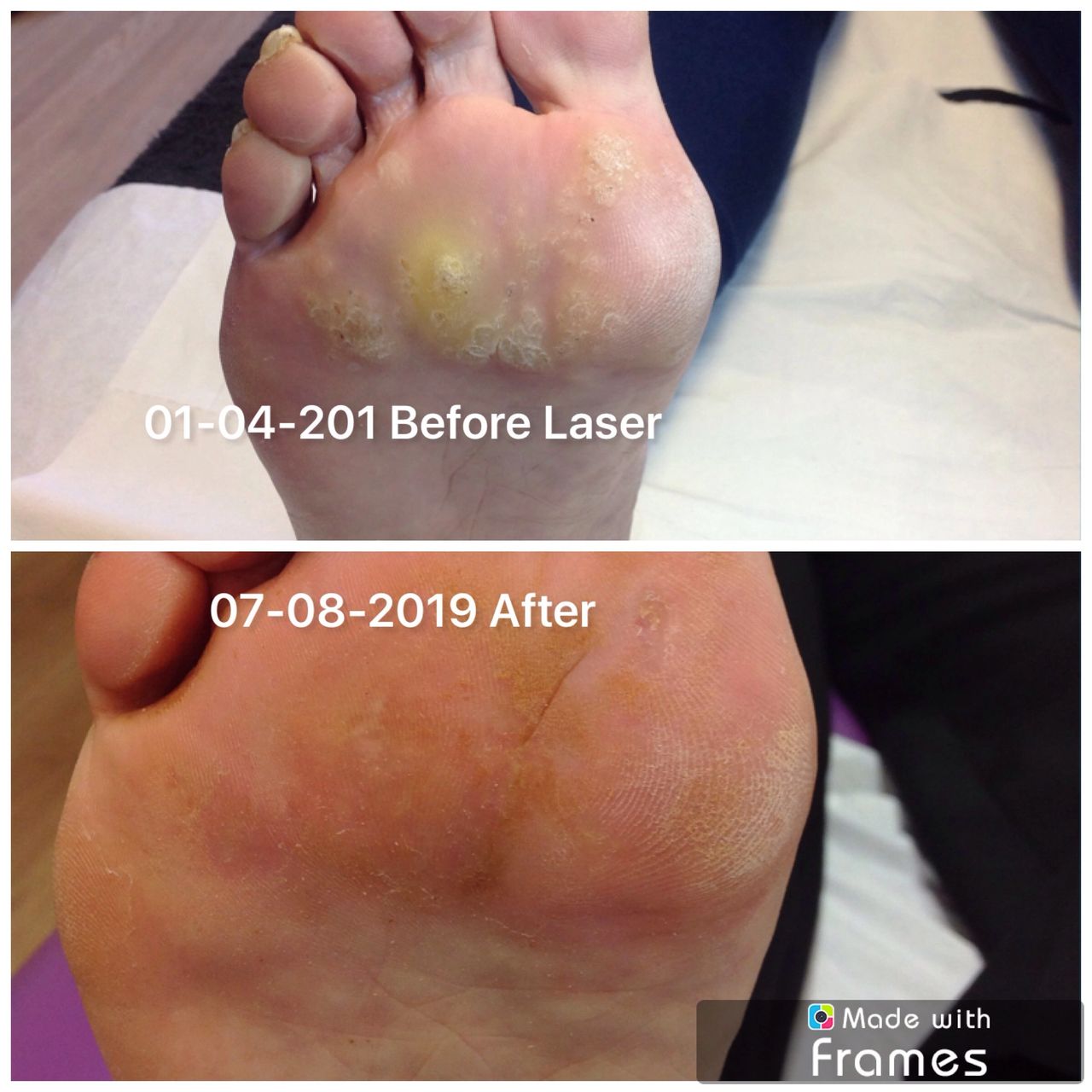 Laser Verruca Treatment Success for Chronic Infection