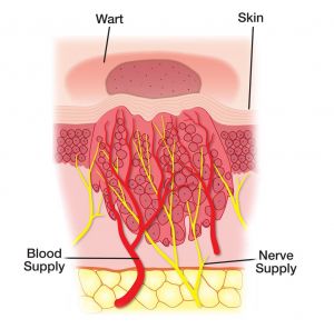 Viral warts - Dermatology & Co : Dermatology & Co