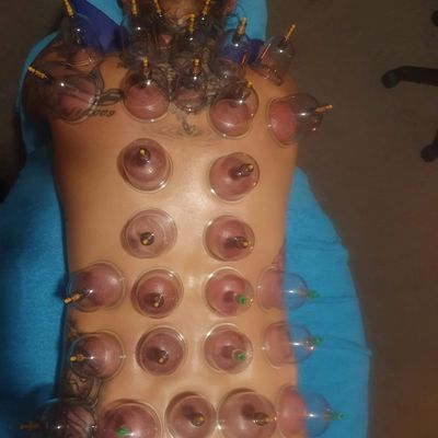 Myofascial Cupping Canberra
