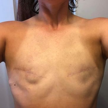 Breast reduction or mastectomy