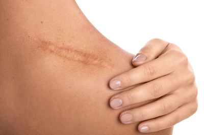 Scar Massage Therapy for Women