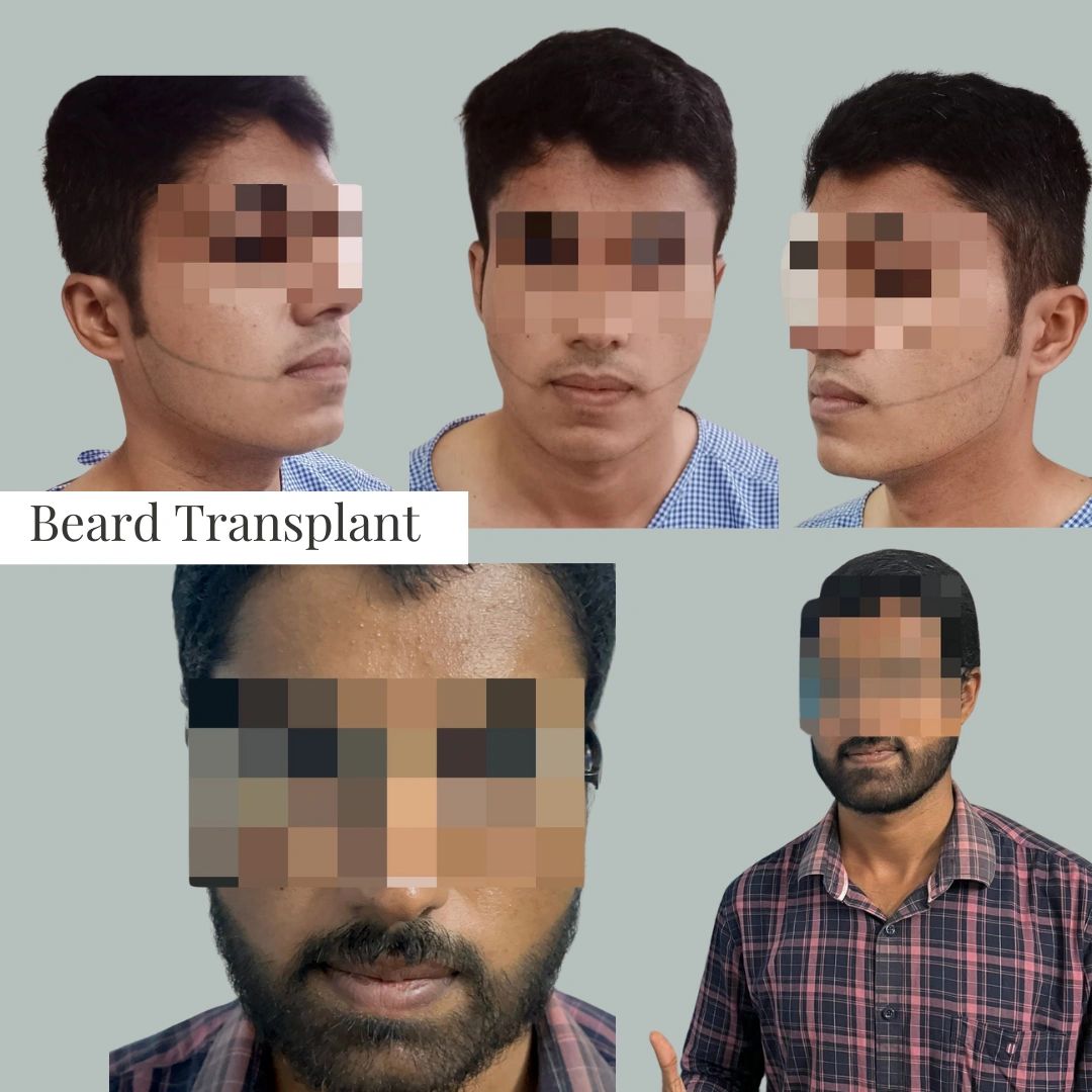 Glutathione IV Treatment in Chennai for Brighter & Glowing Skin