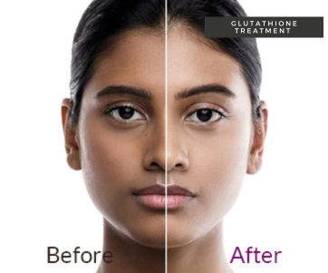 glutathione scientific evidence Glutathione IV for Detox & Anti-Aging from Within