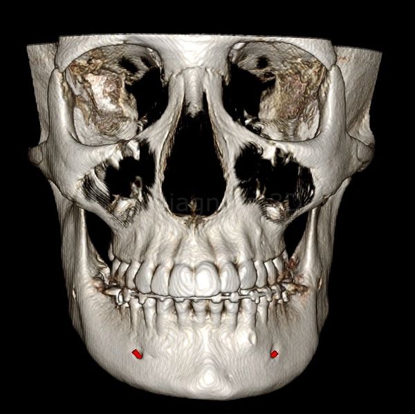 3D Anterior view of the Maxillofacial Skeleton