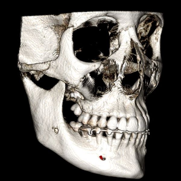 3D Side view of the Maxillofacial Skeleton