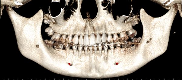 CBCT derived Osseous Panoramic view (OPG) of the Jaws