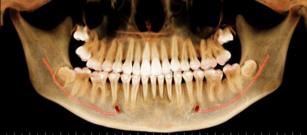 CBCT derived  Panoramic view (OPG) of the Jaws