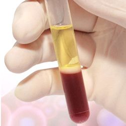 مدى فعالية ابر البلازما لعلاج الضعف الجنسي الشديد مدى فعالية ابر البلازما لعلاج الضعف الجنسي الشديد