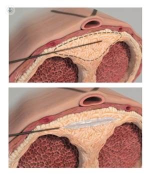 زراعة دعامةاو مرض بايروني القضيب للمرضى المصابين بتليف القضيب  زراعة دعامةاو مرض بايروني القضيب للمرضى المصابين بتليف القضيب