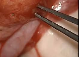 التفتيش عن الحيوانات المنوية باستخدام الميكروسكوب 