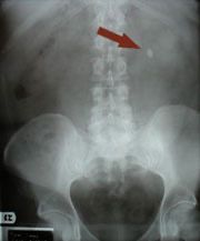 تفتيت حصى الكلى بالاموتج الصادمة. قبل التفتيت