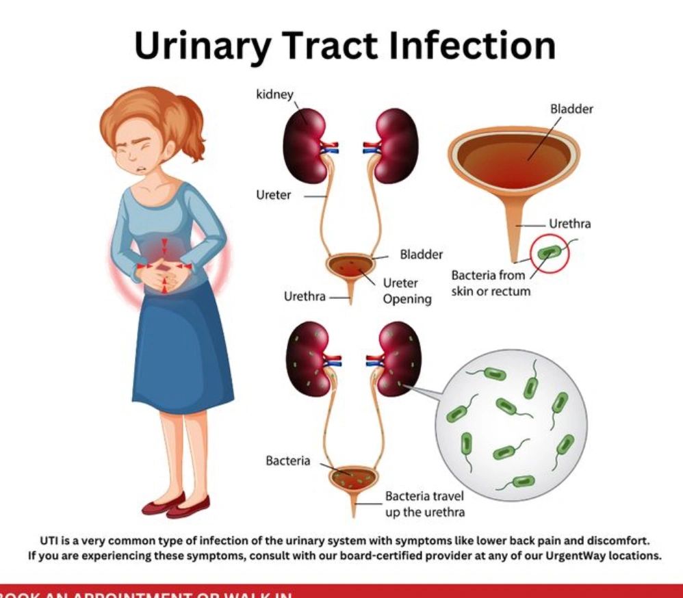 التهاب المسالك البولية 