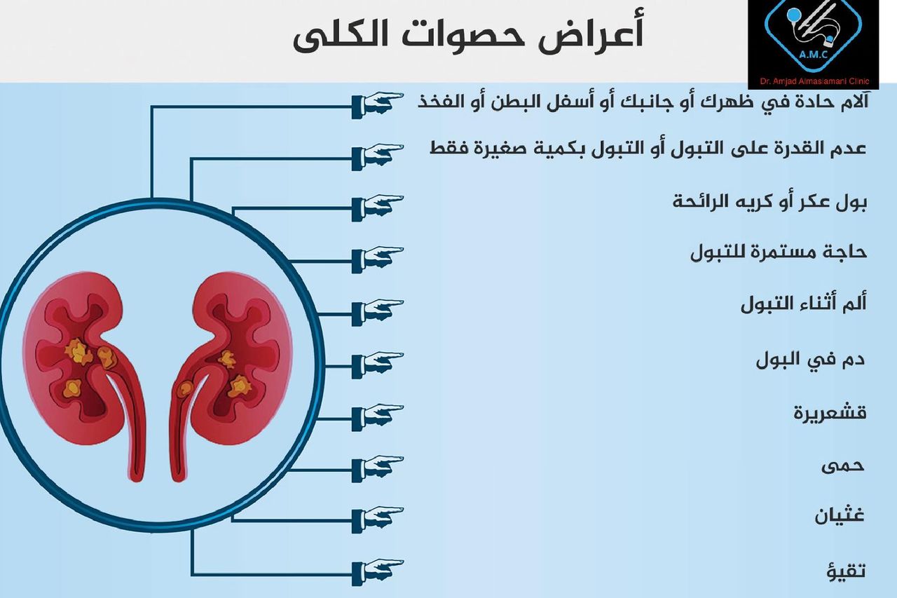 اعراض حصى الكلى