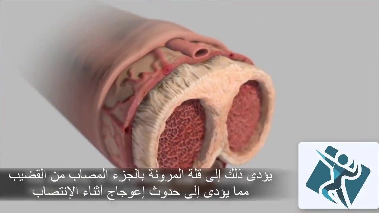 العناية بالمريض بعد عملية زراعة دعامات القضيب و اسعار عملية زراعة الدعامات في الاردن