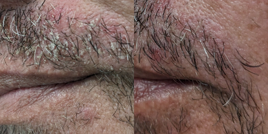 Seborrheic Dermatitis before after