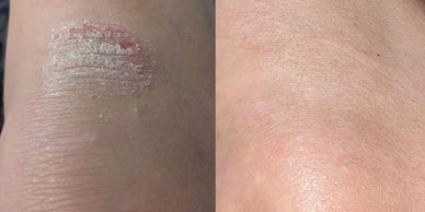 Psoriasis Before and After